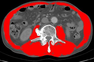 The coexistence of myosteatosis and the creatinine/cystatin C ratio are determinants of outcomes in cholangiocarcinoma patients undergoing curative surgery